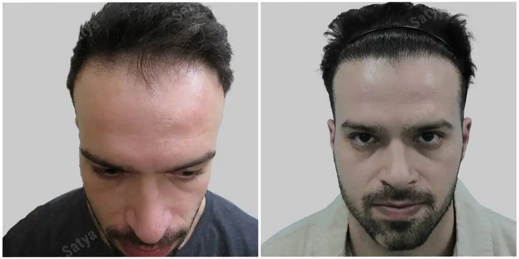 Hair transplant result