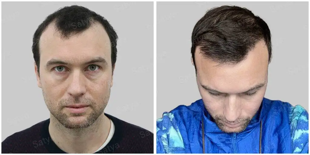 Adam from Sweden β before and after